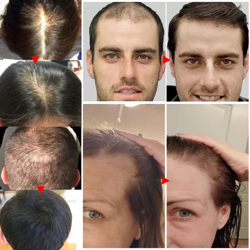 2023 Biotin minyak penumbuh ra - Epidermal Growth Factor ulasan dan harga